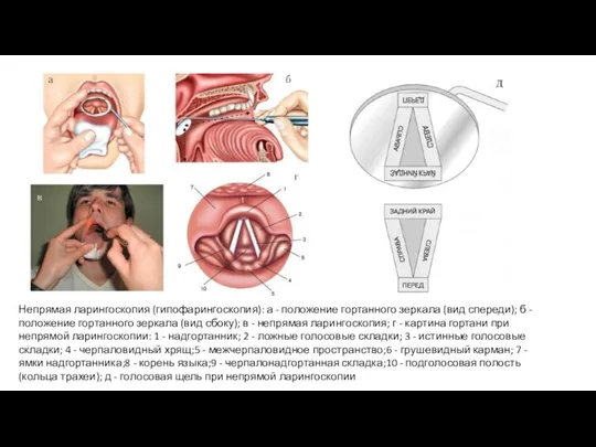 Непрямая ларингоскопия (гипофарингоскопия): а - положение гортанного зеркала (вид спереди);