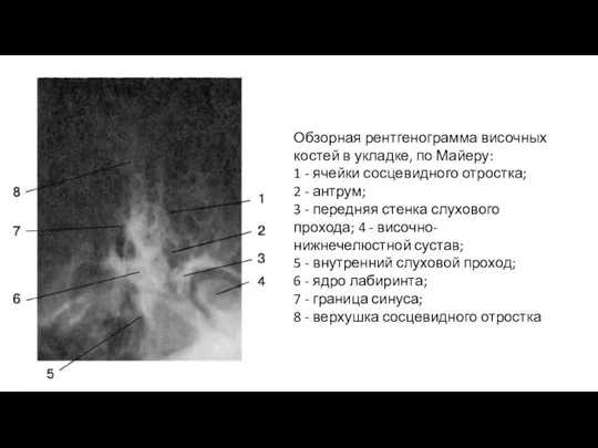 Обзорная рентгенограмма височных костей в укладке, по Майеру: 1 -