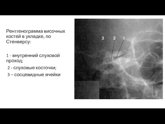 Рентгенограмма височных костей в укладке, по Стенверсу: 1 - внутренний