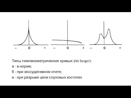 Типы тимпанометрических кривых (по Serger): а - в норме; б