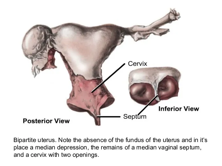 Bipartite uterus. Note the absence of the fundus of the