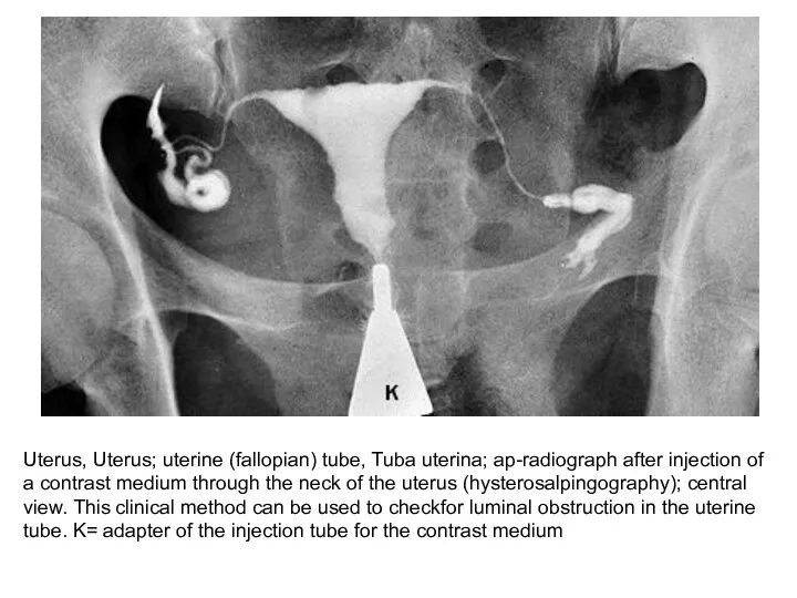 Uterus, Uterus; uterine (fallopian) tube, Tuba uterina; ap-radiograph after injection of a contrast