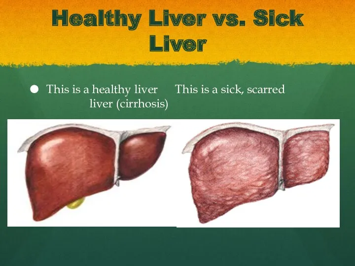 Healthy Liver vs. Sick Liver This is a healthy liver