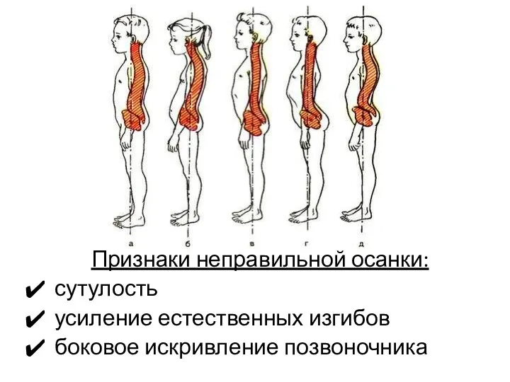 Признаки неправильной осанки: сутулость усиление естественных изгибов боковое искривление позвоночника