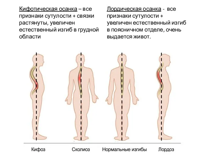 Кифотическая осанка – все признаки сутулости + связки растянуты, увеличен