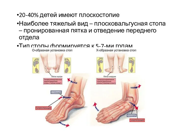 20-40% детей имеют плоскостопие Наиболее тяжелый вид – плосковальгусная стопа