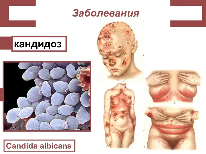 Заболевания Candida albicans