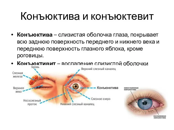 Конъюктива и конъюктевит Конъюктива – слизистая оболочка глаза, покрывает всю