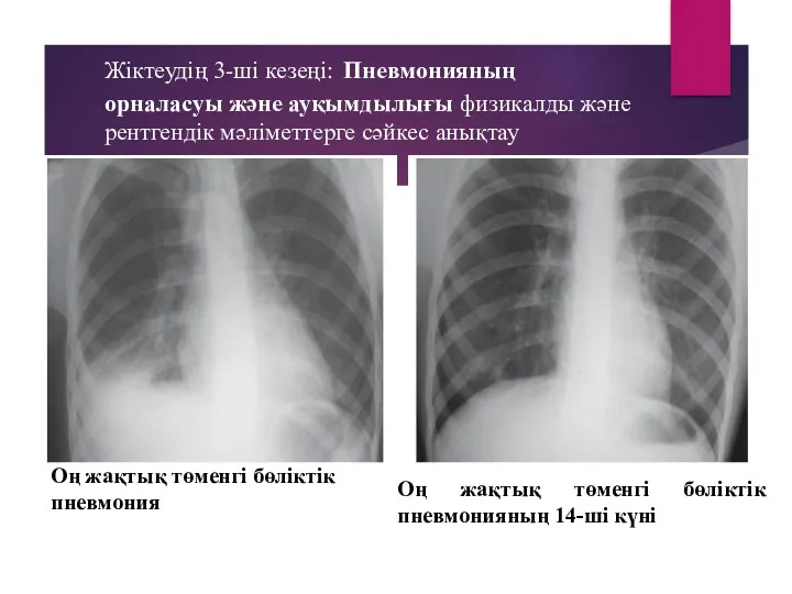 Жіктеудің 3-ші кезеңі: Пневмонияның орналасуы және ауқымдылығы физикалды және рентгендік