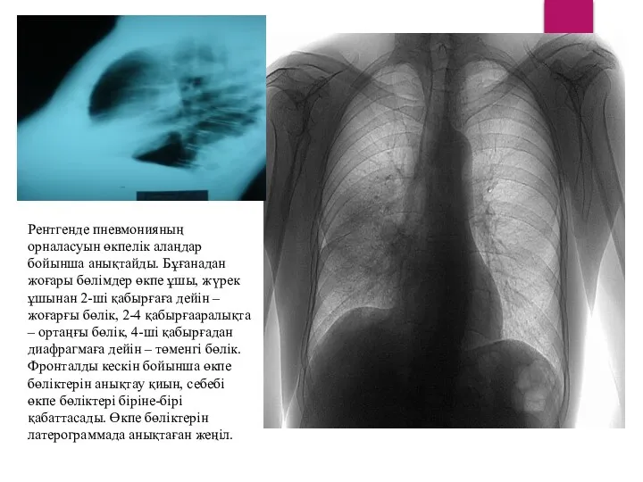 Рентгенде пневмонияның орналасуын өкпелік алаңдар бойынша анықтайды. Бұғанадан жоғары бөлімдер