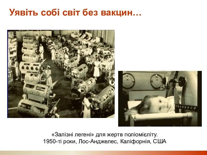 Уявіть собі світ без вакцин… «Залізні легені» для жертв поліомієліту. 1950-ті роки, Лос-Анджелес, Каліфорнія, США