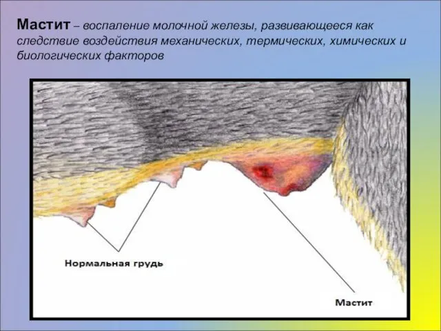 Мастит – воспаление молочной железы, развивающееся как следствие воздействия механических, термических, химических и биологических факторов