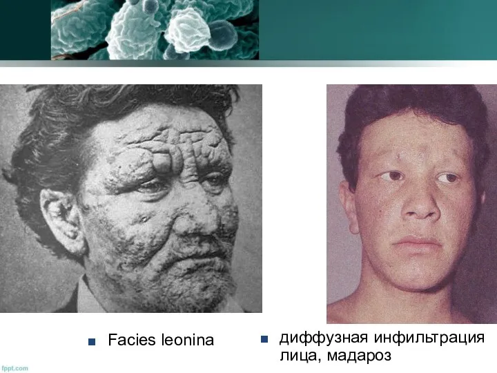 диффузная инфильтрация лица, мадароз Facies leonina