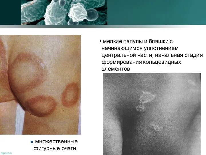 мелкие папулы и бляшки с начинающимся уплотнением центральной части; начальная