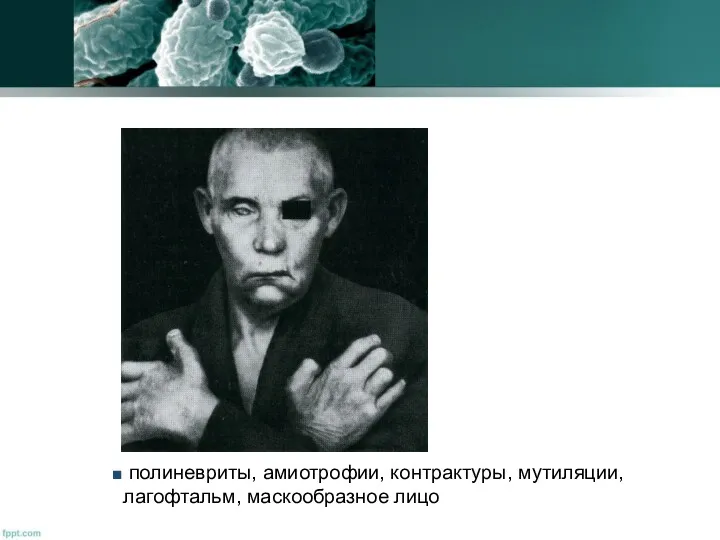 полиневриты, амиотрофии, контрактуры, мутиляции, лагофтальм, маскообразное лицо