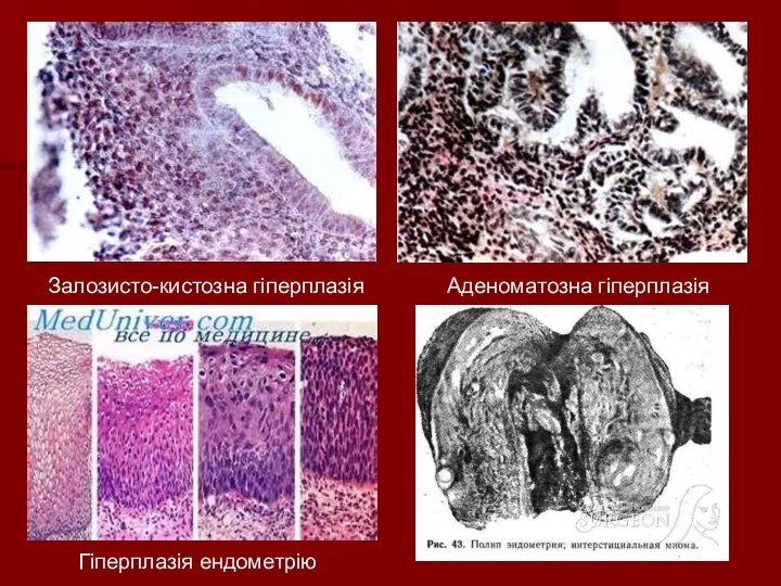 Залозисто-кистозна гіперплазія Аденоматозна гіперплазія Гіперплазія ендометрію