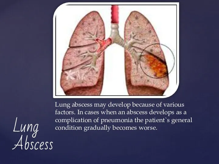 Lung abscess may develop because of various factors. In cases