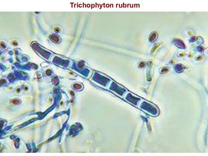 Trichophyton rubrum