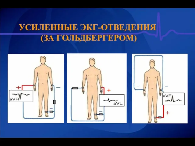 УСИЛЕННЫЕ ЭКГ-ОТВЕДЕНИЯ (ЗА ГОЛЬДБЕРГЕРОМ) +