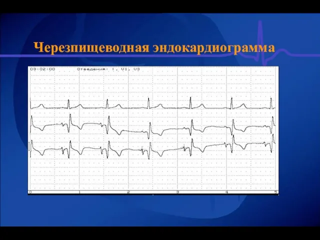 Черезпищеводная эндокардиограмма