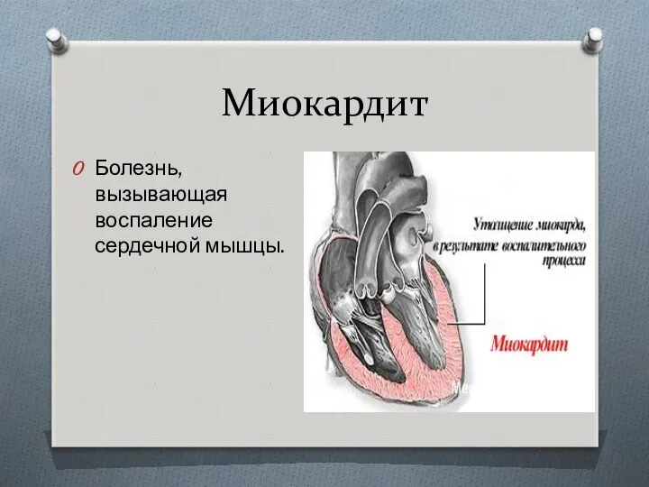 Миокардит Болезнь, вызывающая воспаление сердечной мышцы.