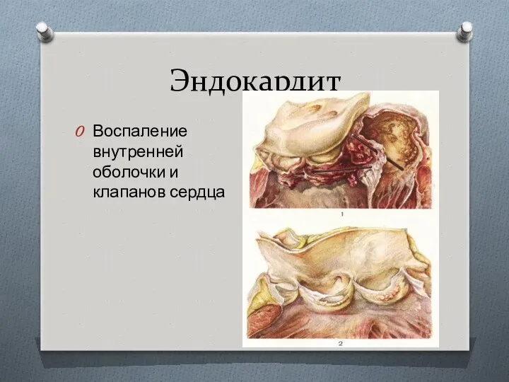 Эндокардит Воспаление внутренней оболочки и клапанов сердца