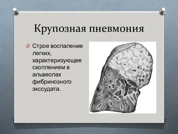 Крупозная пневмония Строе воспаление легких, характеризующее скоплением в альвеолах фибринозного экссудата.