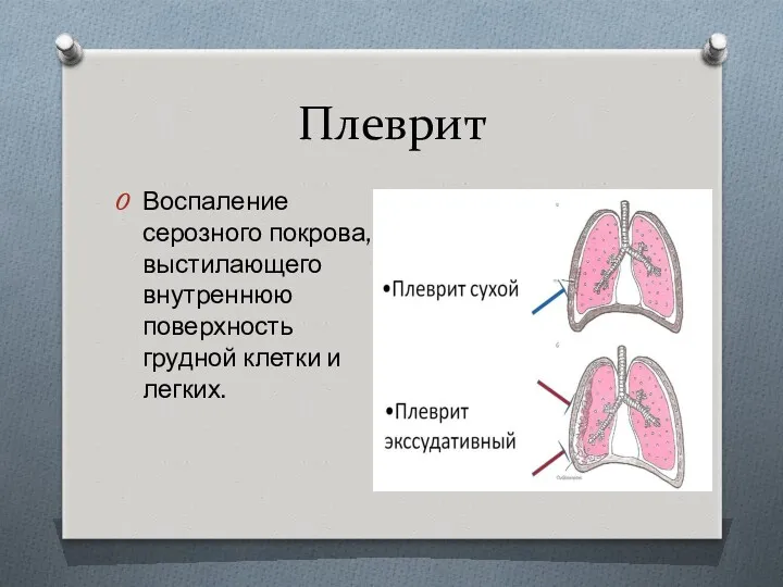 Плеврит Воспаление серозного покрова, выстилающего внутреннюю поверхность грудной клетки и легких.