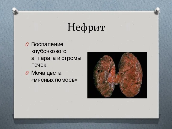 Нефрит Воспаление клубочкового аппарата и стромы почек Моча цвета «мясных помоев»