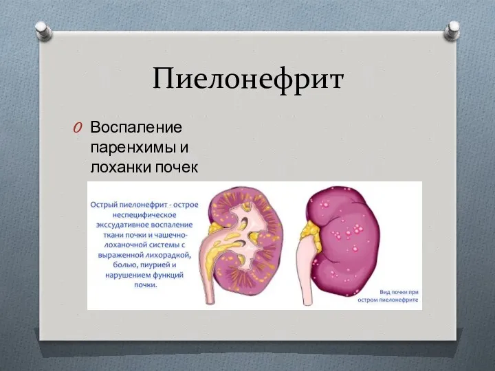 Пиелонефрит Воспаление паренхимы и лоханки почек