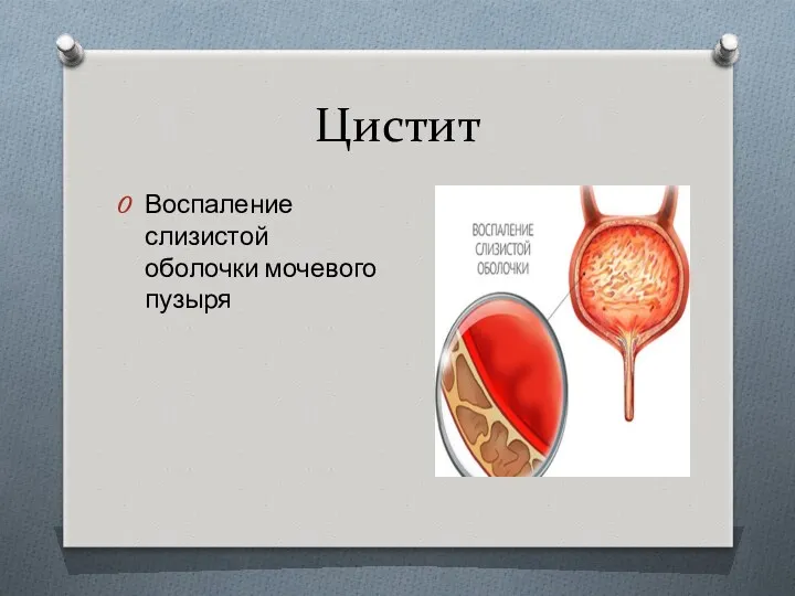 Цистит Воспаление слизистой оболочки мочевого пузыря