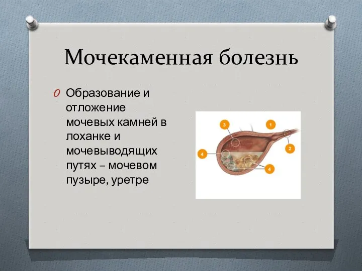 Мочекаменная болезнь Образование и отложение мочевых камней в лоханке и мочевыводящих путях – мочевом пузыре, уретре