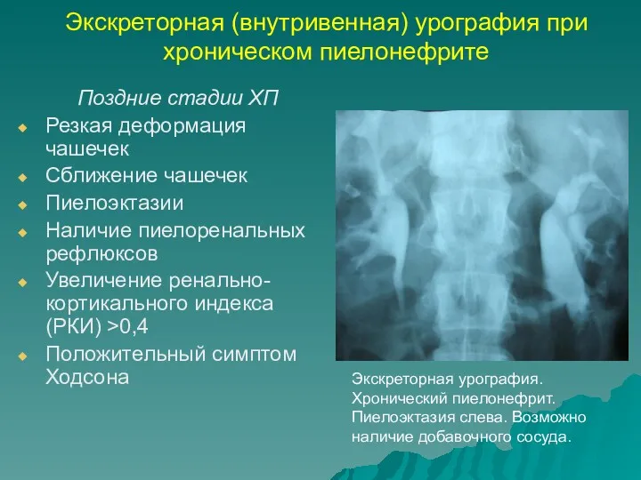 Экскреторная (внутривенная) урография при хроническом пиелонефрите Поздние стадии ХП Резкая