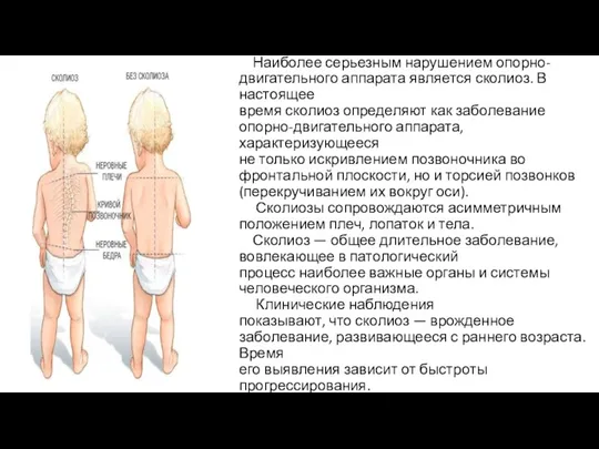 СКОЛИОЗ. Наиболее серьезным нарушением опорно-двигательного аппарата является сколиоз. В настоящее