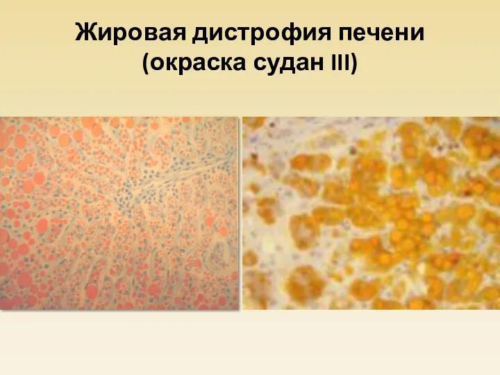 Жировая дистрофия печени (окраска судан III)