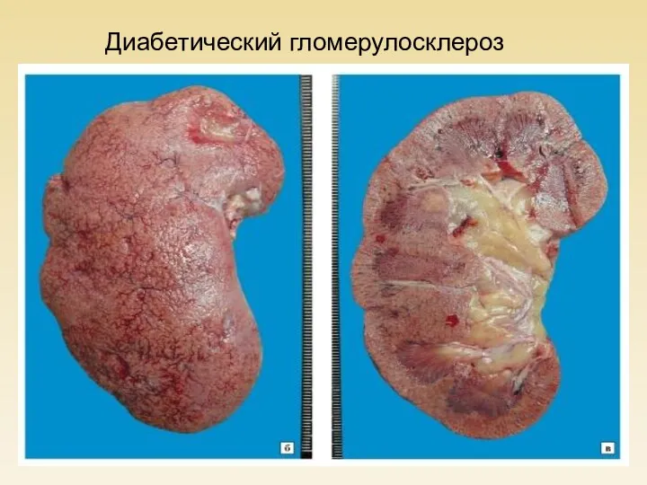 Диабетический гломерулосклероз