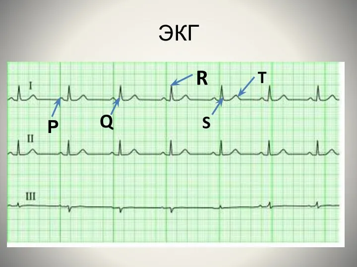 ЭКГ Р Q R S T