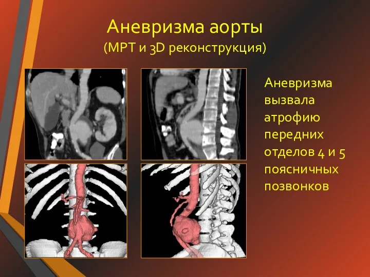 Аневризма аорты (МРТ и 3D реконструкция) Аневризма вызвала атрофию передних отделов 4 и 5 поясничных позвонков