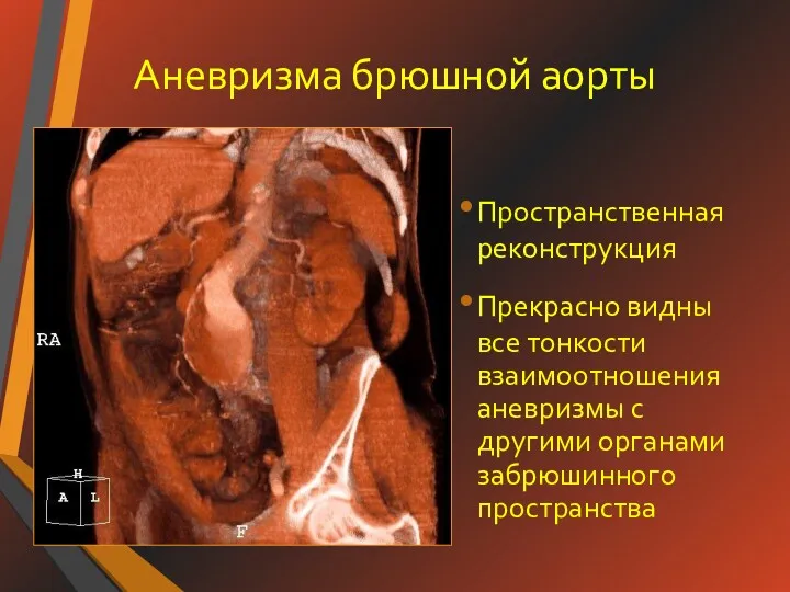 Аневризма брюшной аорты Пространственная реконструкция Прекрасно видны все тонкости взаимоотношения аневризмы с другими органами забрюшинного пространства