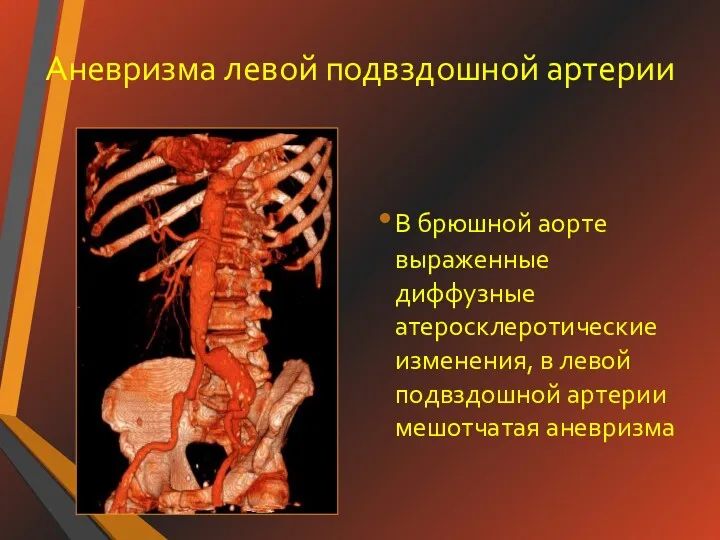 Аневризма левой подвздошной артерии В брюшной аорте выраженные диффузные атеросклеротические
