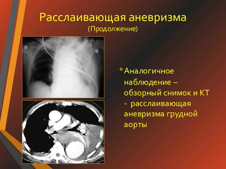 Расслаивающая аневризма (Продолжение) Аналогичное наблюдение – обзорный снимок и КТ - расслаивающая аневризма грудной аорты