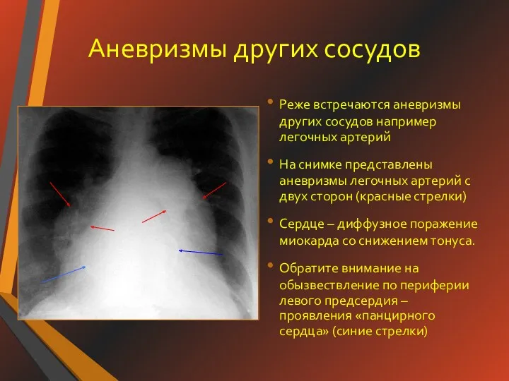 Аневризмы других сосудов Реже встречаются аневризмы других сосудов например легочных