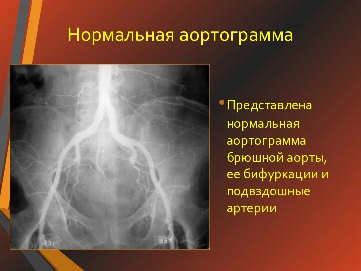 Нормальная аортограмма Представлена нормальная аортограмма брюшной аорты, ее бифуркации и подвздошные артерии