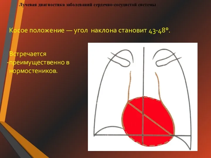 Лучевая диагностика заболеваний сердечно-сосудистой системы Косое положение — угол наклона становит 43-48°. Встречается преимущественно в нормостеников.