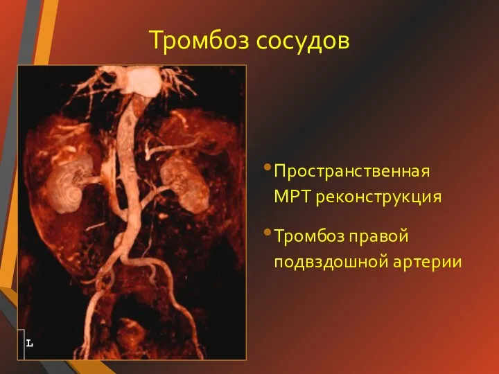 Тромбоз сосудов Пространственная МРТ реконструкция Тромбоз правой подвздошной артерии