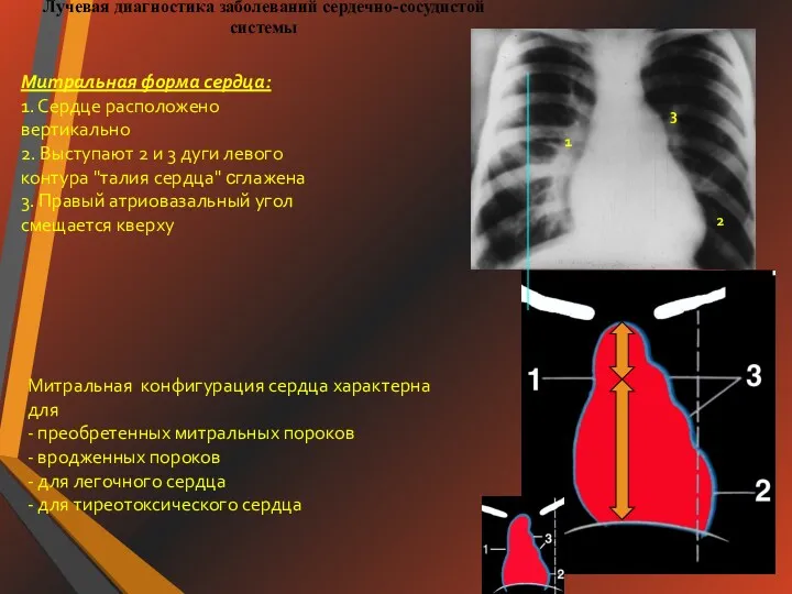 Лучевая диагностика заболеваний сердечно-сосудистой системы Митральная форма сердца: 1. Сердце