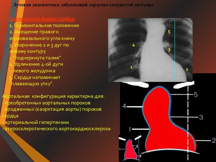 Лучевая диагностика заболеваний сердечно-сосудистой системы Аортальная форма сердца 1. Горизонтальное