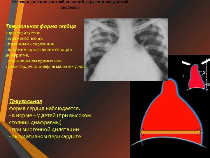 Лучевая диагностика заболеваний сердечно-сосудистой системы Треугольная форма сердца наблюдается: -