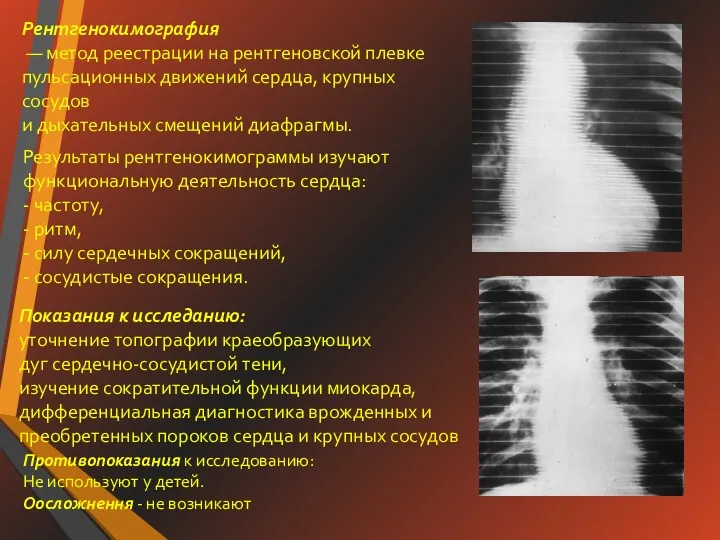 Рентгенокимография — метод реестрации на рентгеновской плевке пульсационных движений сердца,