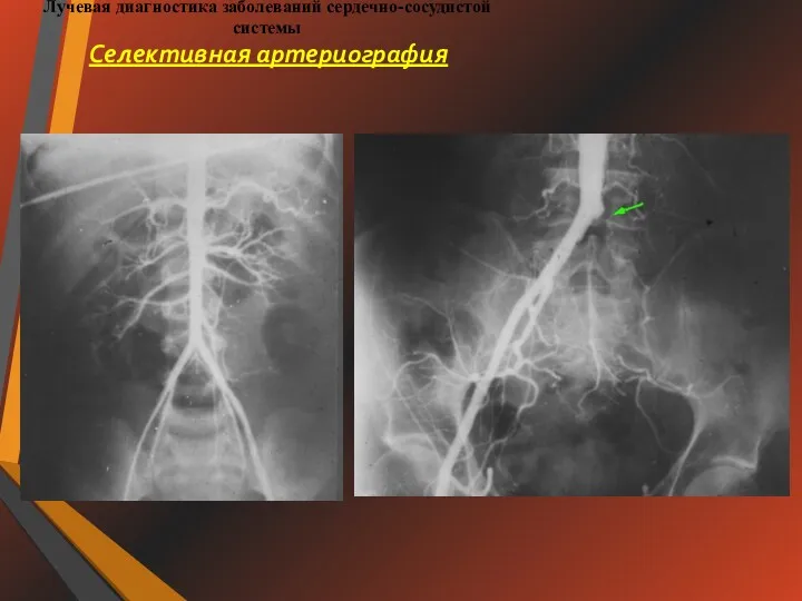 Лучевая диагностика заболеваний сердечно-сосудистой системы Селективная артериография
